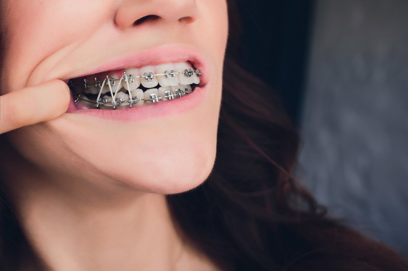 What role do elastics (rubber bands) play in orthodontics? - Dr