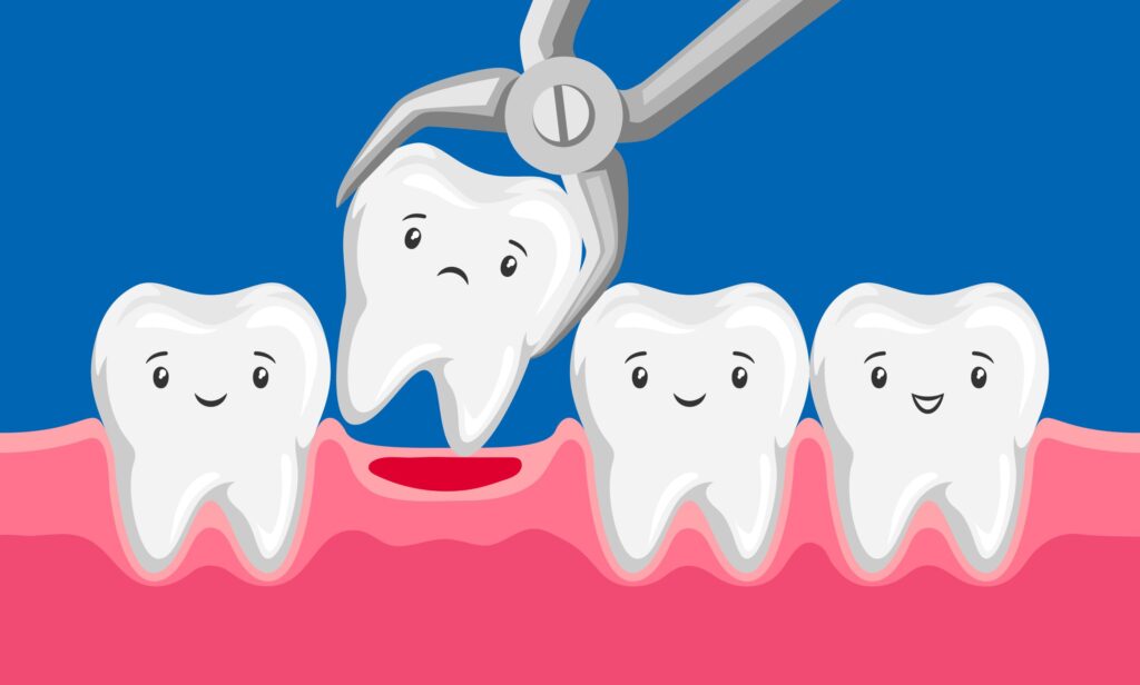 Illustration of three animated teeth smiling while a fourth frowns at being extracted